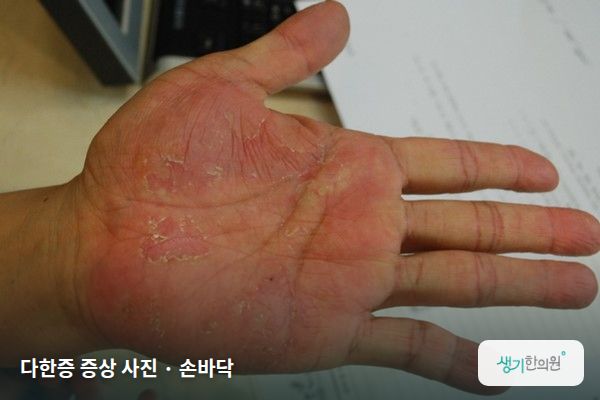 손바닥에 생긴 다한증 증상 사진 — 다한증 증상 사진 · 손바닥