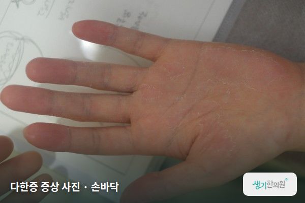 손바닥에 생긴 다한증 증상 사진 — 다한증 증상 사진 · 손바닥