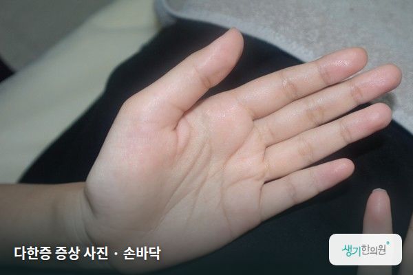 손바닥에 생긴 다한증 증상 사진 — 다한증 증상 사진 · 손바닥