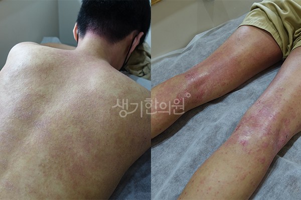 생기한의원 노원점에서 촬영한 등과 다리의 성인아토피 증상 사진