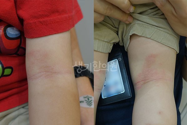 생기한의원 노원점에서 촬영한 아이 팔의 소아아토피 증상 사진