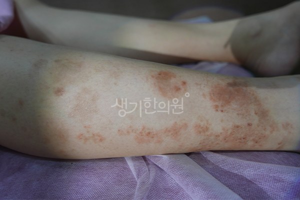 생기한의원 노원점에서 촬영한 정강이의 화폐상습진 증상 사진