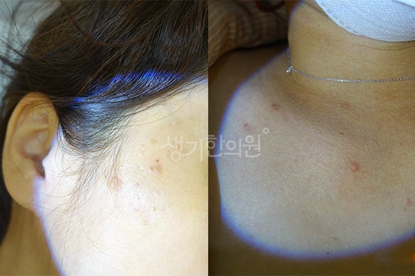 생기한의원 노원점에서 촬영한 귀 주변과 목의 편평사마귀 증상 사진