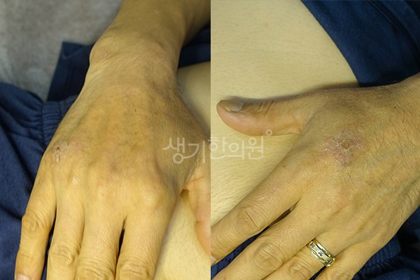 생기한의원 노원점에서 촬영한 손등과 손가락의 습진 증상 사진