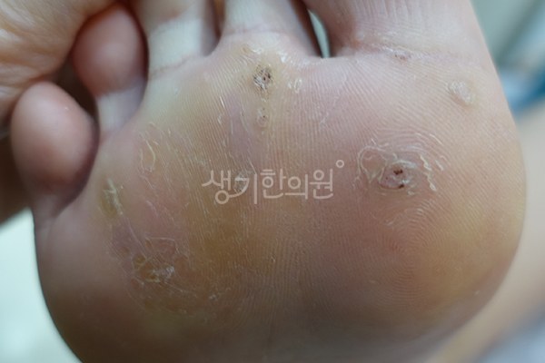 생기한의원 노원점에서 촬영한 발바닥의 사마귀 증상 사진