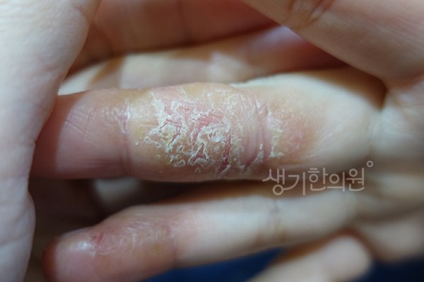 생기한의원 노원점에서 촬영한 손가락의 한포진 증상 사진