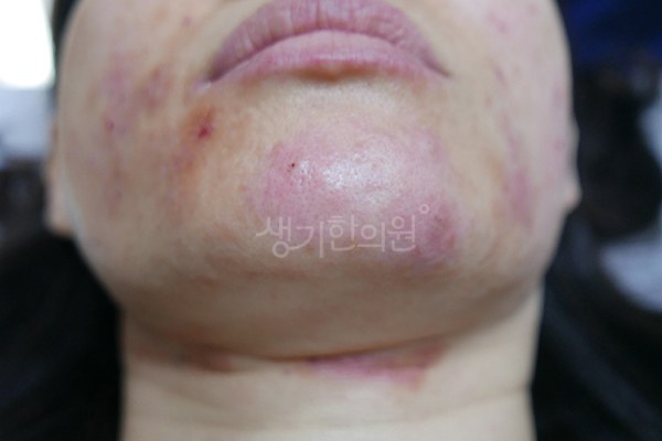 생기한의원 노원점에서 촬영한 턱의 지루성피부염 증상 사진