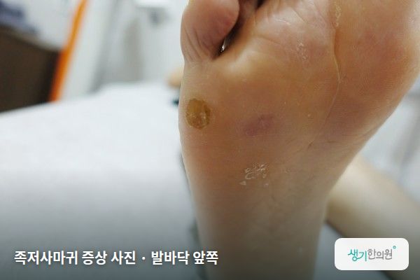 발바닥 앞쪽에 생긴 족저사마귀 증상 사진 — 족저사마귀 증상 사진 · 발바닥 앞쪽