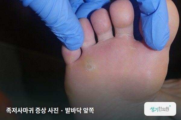 발바닥 앞쪽에 생긴 족저사마귀 증상 사진 — 족저사마귀 증상 사진 · 발바닥 앞쪽
