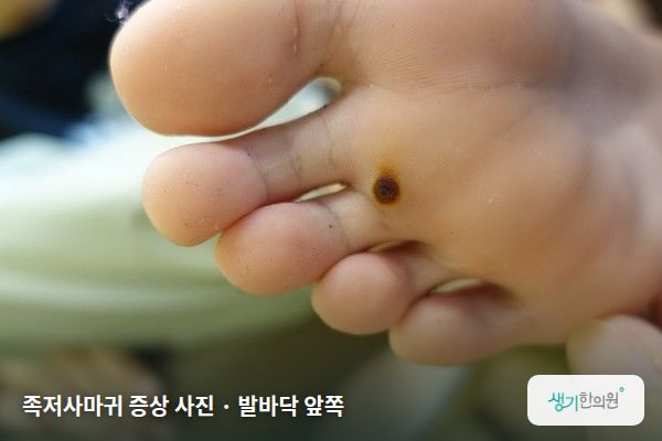 발바닥 앞쪽에 생긴 족저사마귀 증상 사진 — 족저사마귀 증상 사진 · 발바닥 앞쪽