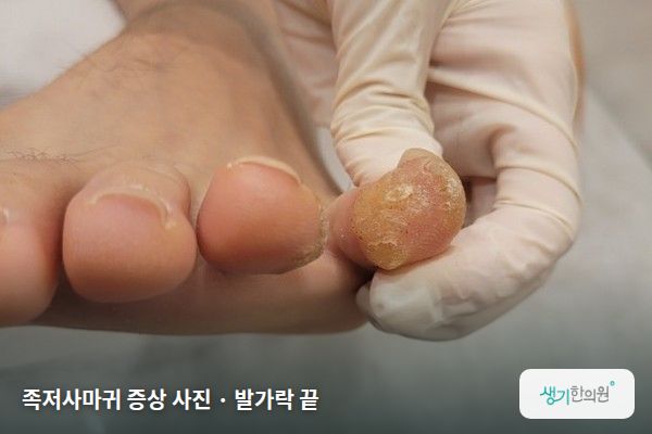발가락 끝에 생긴 족저사마귀 증상 사진 — 족저사마귀 증상 사진 · 발가락 끝