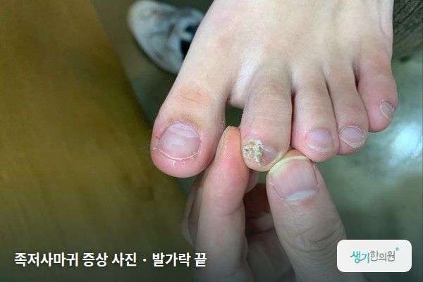 발가락 끝에 생긴 족저사마귀 증상 사진 — 족저사마귀 증상 사진 · 발가락 끝