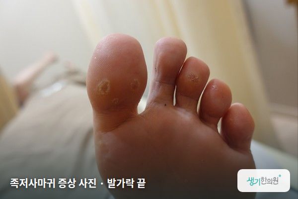 발가락 끝에 생긴 족저사마귀 증상 사진 — 족저사마귀 증상 사진 · 발가락 끝