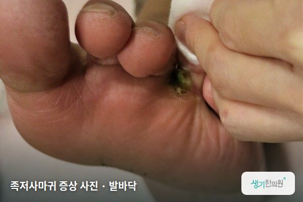 발바닥에 생긴 족저사마귀 증상 사진 — 족저사마귀 증상 사진 · 발바닥