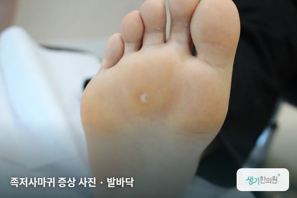 발바닥에 생긴 족저사마귀 증상 사진 — 족저사마귀 증상 사진 · 발바닥