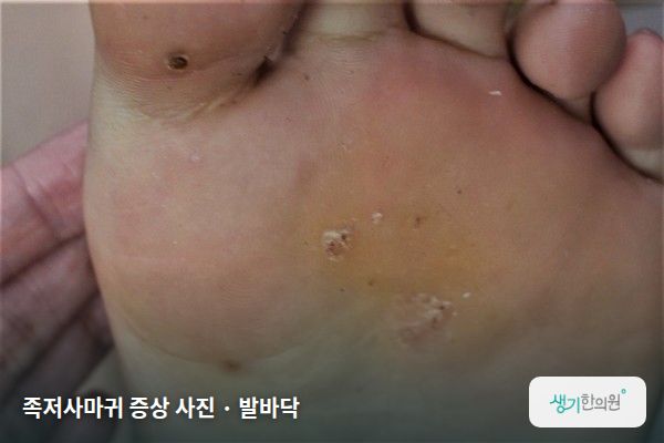 발바닥에 생긴 족저사마귀 증상 사진 — 족저사마귀 증상 사진 · 발바닥