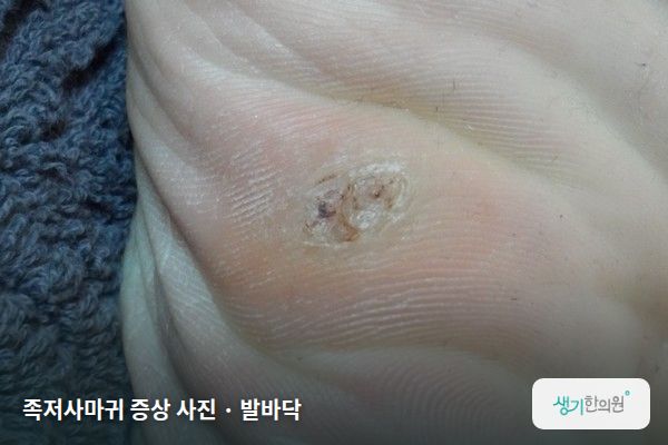 발바닥에 생긴 족저사마귀 증상 사진 — 족저사마귀 증상 사진 · 발바닥