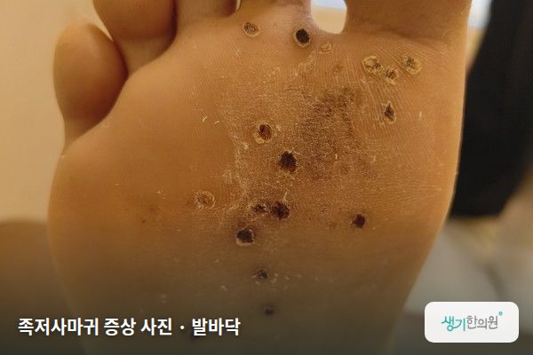 발바닥에 생긴 족저사마귀 증상 사진 — 족저사마귀 증상 사진 · 발바닥
