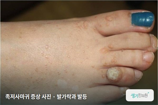 발가락과 발등에 생긴 족저사마귀 증상 사진 — 족저사마귀 증상 사진 · 발가락과 발등