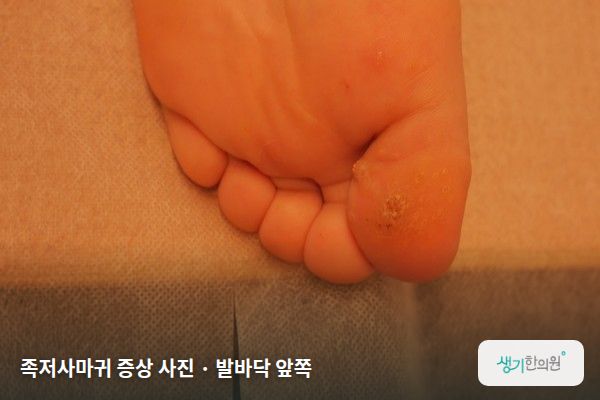 발바닥 앞쪽에 생긴 족저사마귀 증상 사진 — 족저사마귀 증상 사진 · 발바닥 앞쪽