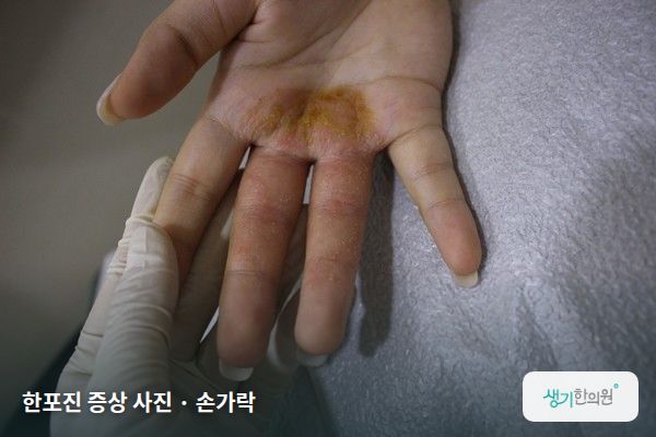손가락에 생긴 한포진 증상 사진 — 한포진 증상 사진 · 손가락