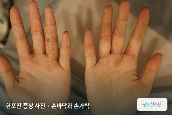 손바닥과 손가락에 생긴 한포진 증상 사진 — 한포진 증상 사진 · 손바닥과 손가락