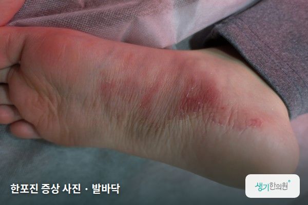 발바닥에 생긴 한포진 증상 사진 — 한포진 증상 사진 · 발바닥