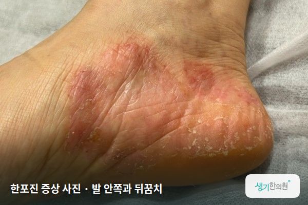 발 안쪽과 뒤꿈치에 생긴 한포진 증상 사진 — 한포진 증상 사진 · 발 안쪽과 뒤꿈치