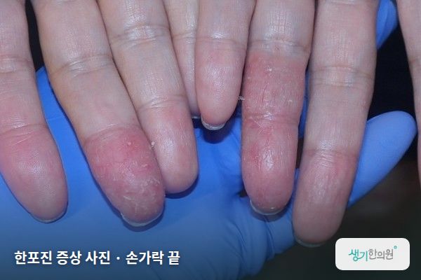 손가락 끝에 생긴 한포진 증상 사진 — 한포진 증상 사진 · 손가락 끝