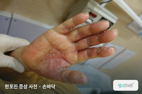 손바닥에 생긴 한포진 증상 사진 — 한포진 증상 사진 · 손바닥