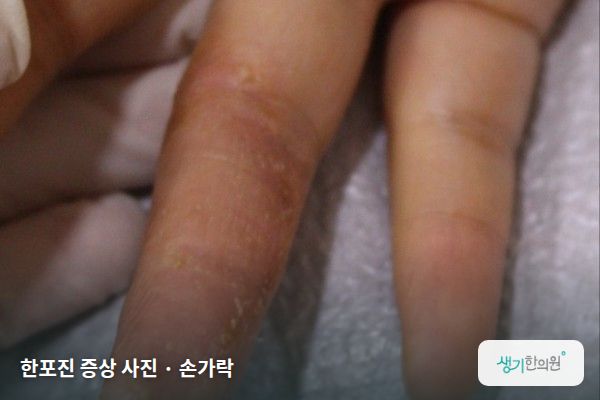 손가락에 생긴 한포진 증상 사진 — 한포진 증상 사진 · 손가락