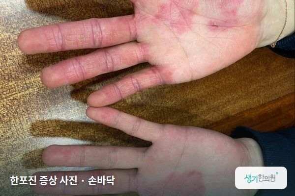 손바닥에 생긴 한포진 증상 사진 — 한포진 증상 사진 · 손바닥