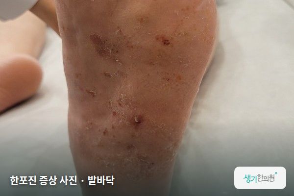 발바닥에 생긴 한포진 증상 사진 — 한포진 증상 사진 · 발바닥