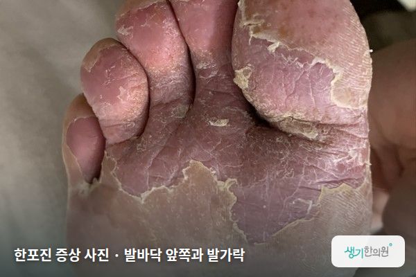 발바닥 앞쪽과 발가락에 생긴 한포진 증상 사진 — 한포진 증상 사진 · 발바닥 앞쪽과 발가락
