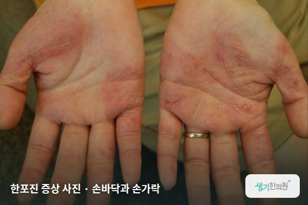 손바닥과 손가락에 생긴 한포진 증상 사진 — 한포진 증상 사진 · 손바닥과 손가락