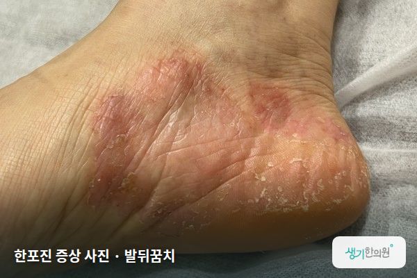 발뒤꿈치에 생긴 한포진 증상 사진 — 한포진 증상 사진 · 발뒤꿈치