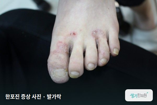발가락에 생긴 한포진 증상 사진 — 한포진 증상 사진 · 발가락