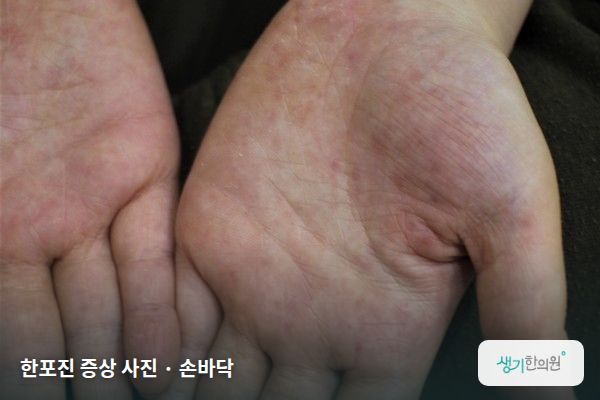 손바닥에 생긴 한포진 증상 사진 — 한포진 증상 사진 · 손바닥