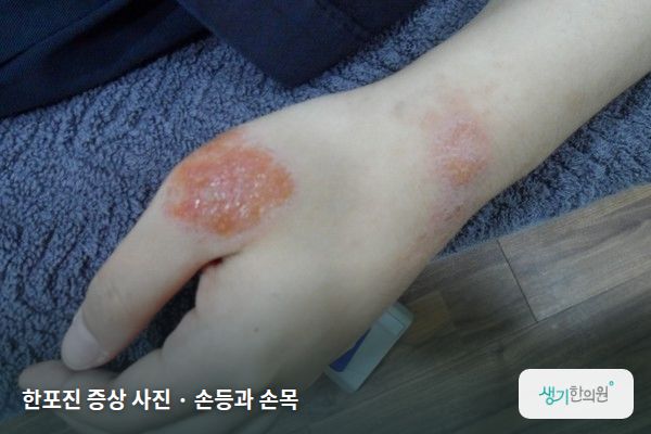 손등과 손목에 생긴 한포진 증상 사진 — 한포진 증상 사진 · 손등과 손목