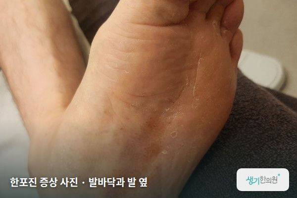 발바닥과 발 옆에 생긴 한포진 증상 사진 — 한포진 증상 사진 · 발바닥과 발 옆