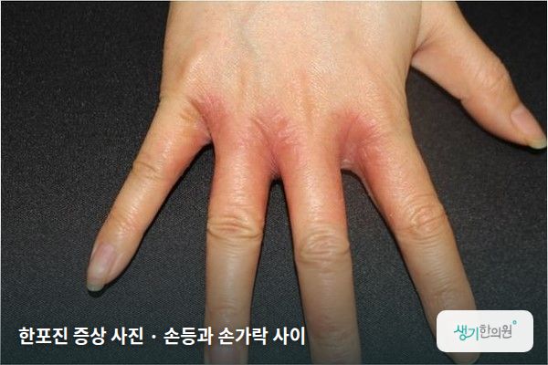 손등과 손가락 사이에 생긴 한포진 증상 사진 — 한포진 증상 사진 · 손등과 손가락 사이