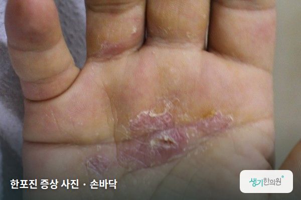 손바닥에 생긴 한포진 증상 사진