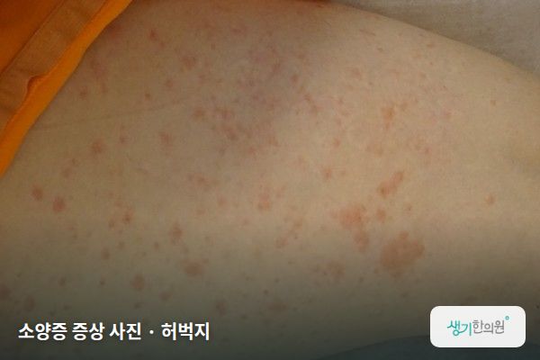 허벅지에 생긴 소양증 증상 사진 — 소양증 증상 사진 · 허벅지