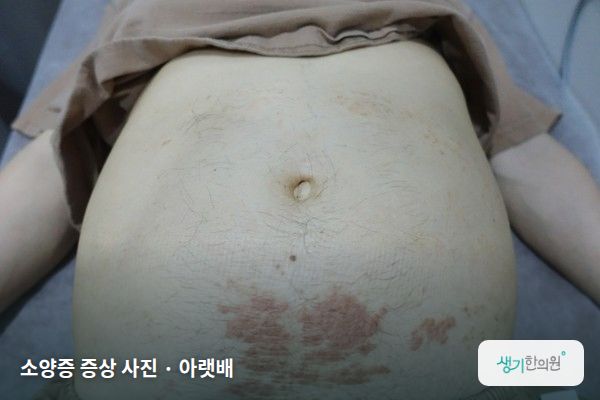 아랫배에 생긴 소양증 증상 사진 — 소양증 증상 사진 · 아랫배