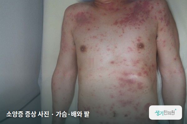 가슴·배와 팔에 생긴 소양증 증상 사진 — 소양증 증상 사진 · 가슴·배와 팔