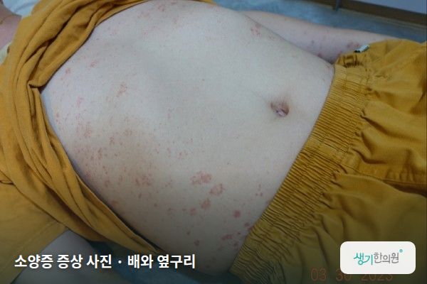 배와 옆구리에 생긴 소양증 증상 사진 — 소양증 증상 사진 · 배와 옆구리