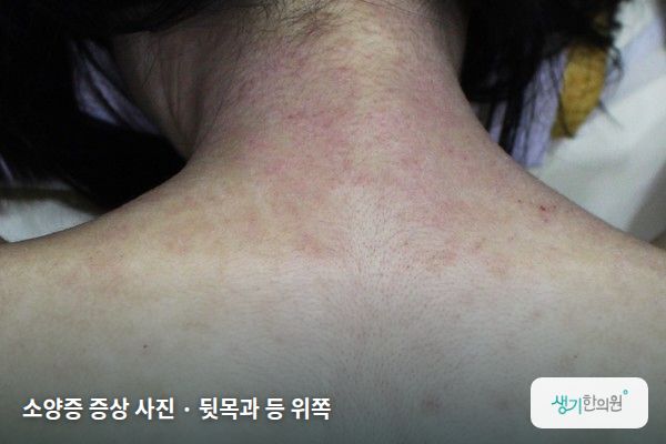뒷목과 등 위쪽에 생긴 소양증 증상 사진 — 소양증 증상 사진 · 뒷목과 등 위쪽