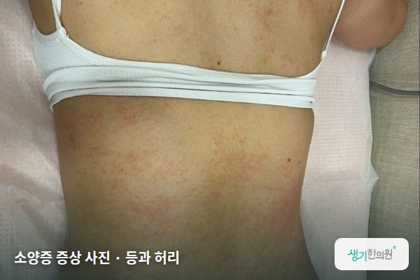 등과 허리에 생긴 소양증 증상 사진 — 소양증 증상 사진 · 등과 허리