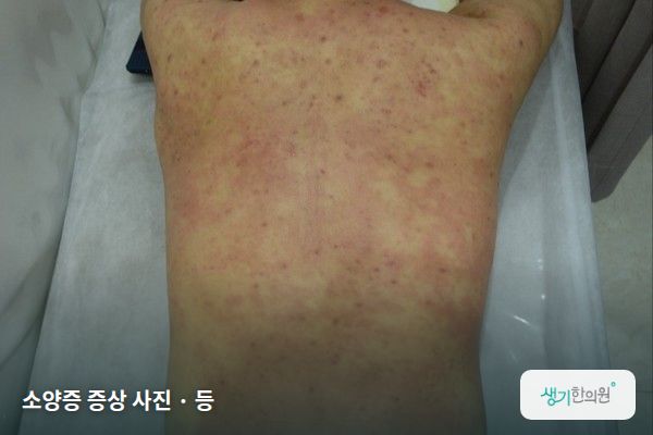 등에 생긴 소양증 증상 사진 — 소양증 증상 사진 · 등