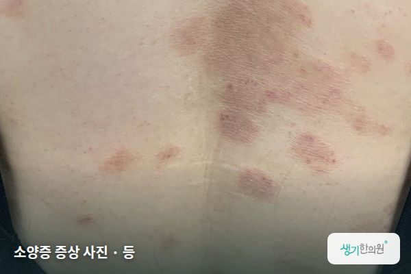 등에 생긴 소양증 증상 사진 — 소양증 증상 사진 · 등